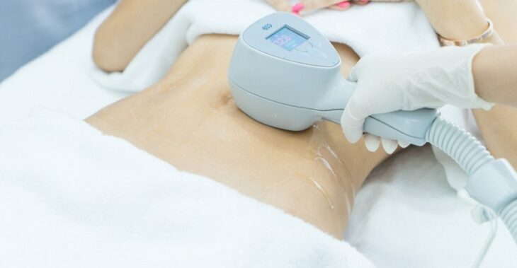 Ứng dụng của sóng RF trong thẩm mỹ